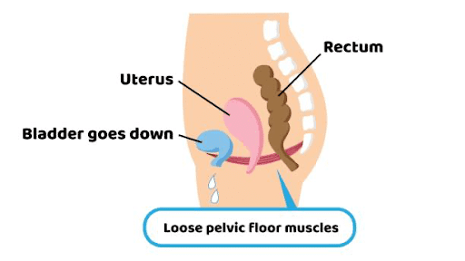Lokasi Otot Dasar Panggul (Pelvic Floor Muscle)
