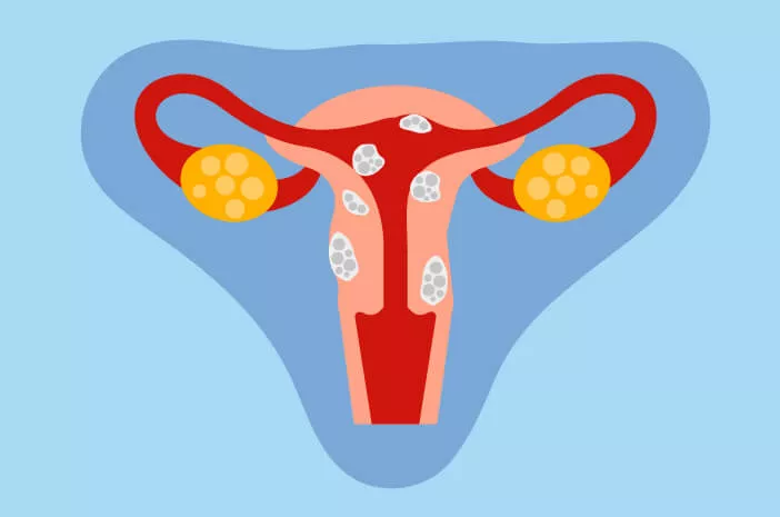 Penyebab Mioma Uteri (sumber: halodoc.com)
